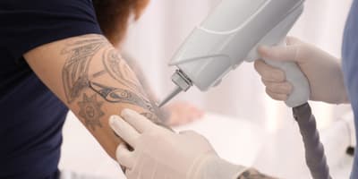 tattoo removal